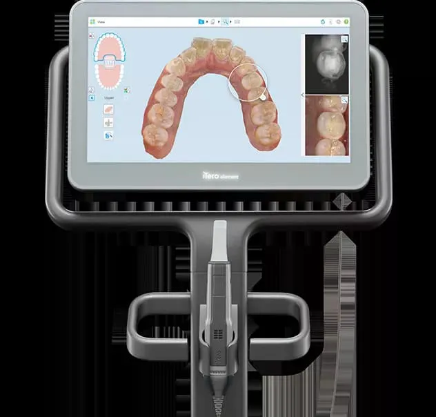 「iTero」による簡易シミュレーションを実施