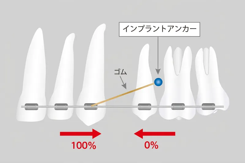 インプラントアンカー