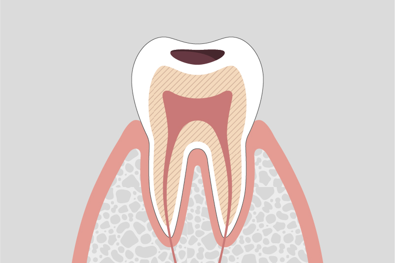 虫歯が象牙質にまで拡大している状態