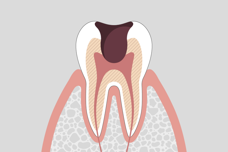 虫歯が神経まで達している状態