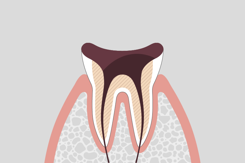 歯の根しか残っていない状態