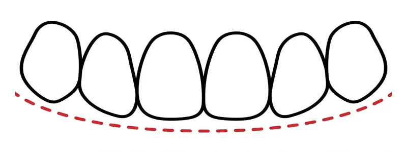 スマイルライン型