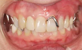 ノンクラスプデンチャーを用いた症例