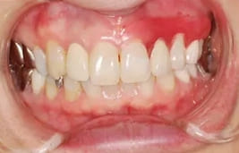 ノンクラスプデンチャーを用いた症例