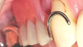 ノンクラスプデンチャーを用いた症例