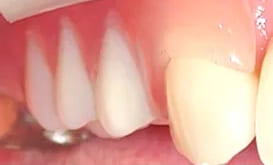 ノンクラスプデンチャーを用いた症例