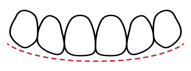 スマイルライン型