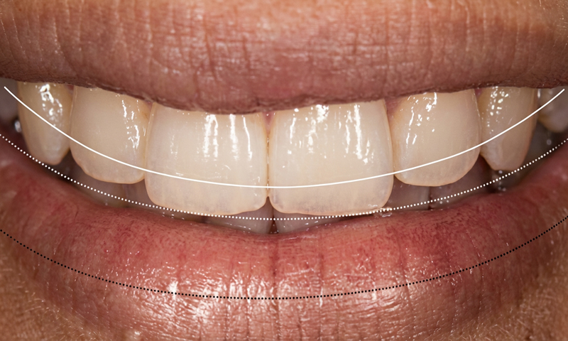 下唇と前歯の「アーチ」