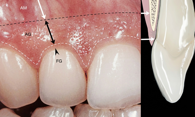 歯茎の自然な美しさ