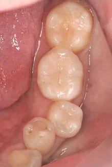 銀歯の詰め物をセラミック素材の詰め物に差し替えた症例１