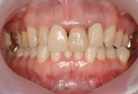 オールセラミッククラウン法で「歯の白さ」と「歯の隙間」を改善した症例