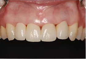 オールセラミッククラウン法で「歯の白さ」と「歯の隙間」を改善した症例