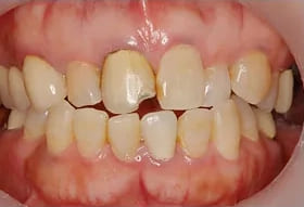 オールセラミッククラウン法で「歯の白さ」と「歯の形」を改善した症例