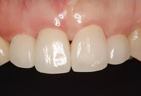 オールセラミッククラウン法で「歯の白さ」と「歯の形」を改善した症例