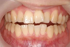 ホワイトニングの症例