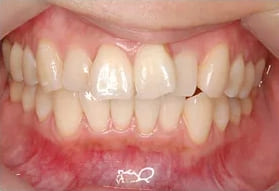 ホワイトニングの症例