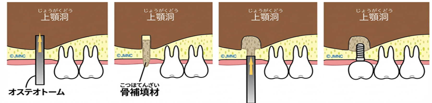 ソケットリフト