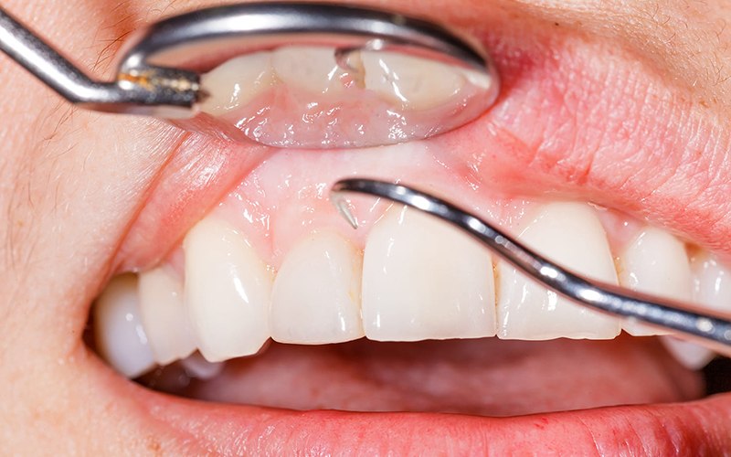 虫歯感染部位がピンポイントでわかる「う蝕検知液」