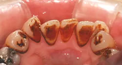 PMTCで歯垢や歯石、着色を除去した症例前