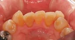 PMTCで歯垢や歯石、着色を除去した症例後