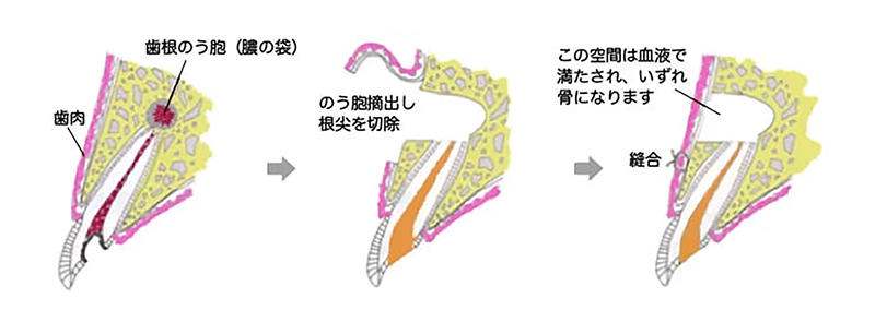 できるだけ歯を残すための「歯根端切除術」